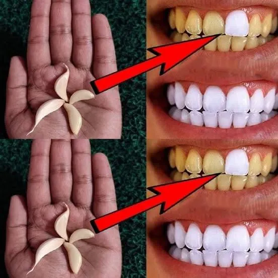 Garlic: An Unexpected Ally for Natural Teeth Whitening