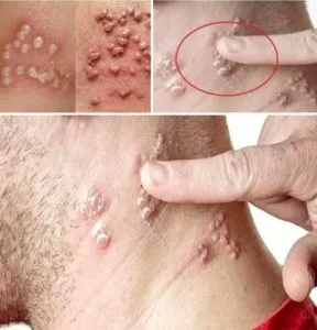 16. A man wakes up with small bubbles on his finger – After examining him, doctors called the police