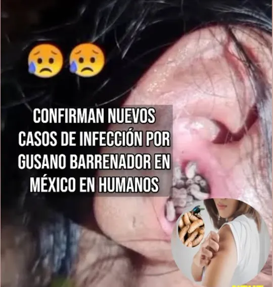 There are now four cases of screwworm myiasis in humans in Chiapas. There are now four cases of screwworm myiasis in humans in Chiapas.