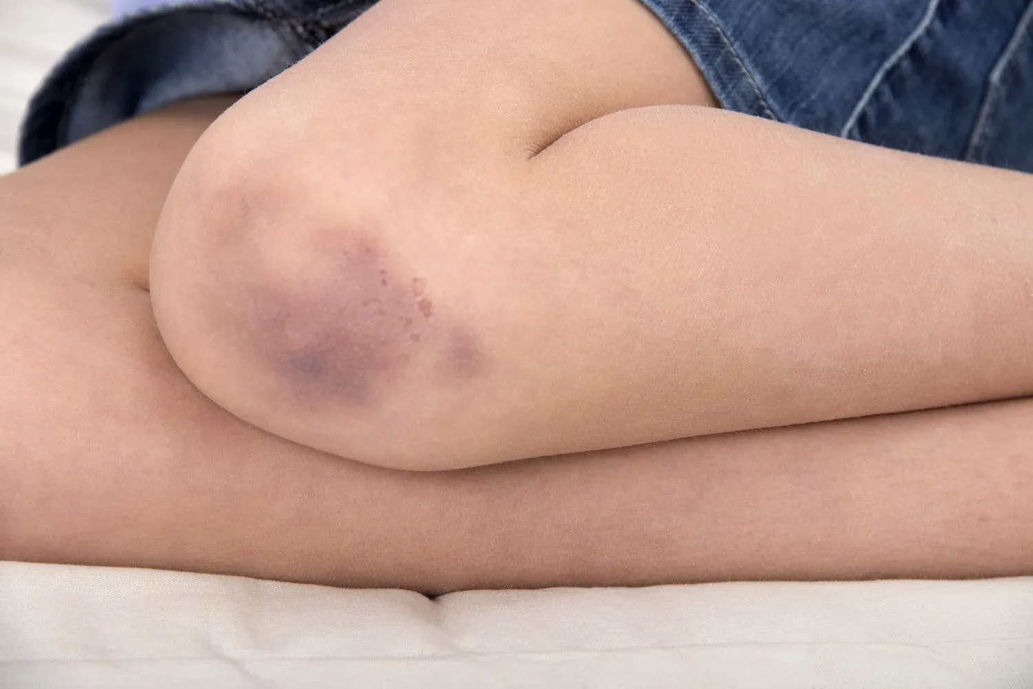 3. Little Girl’s Bruises Kept Getting Worse. When Mom Found Out The Truth, It Was Too Late...