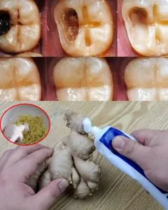 P3. How to naturally repair a cavity. Keep these tips in mind to avoid visiting the dentist