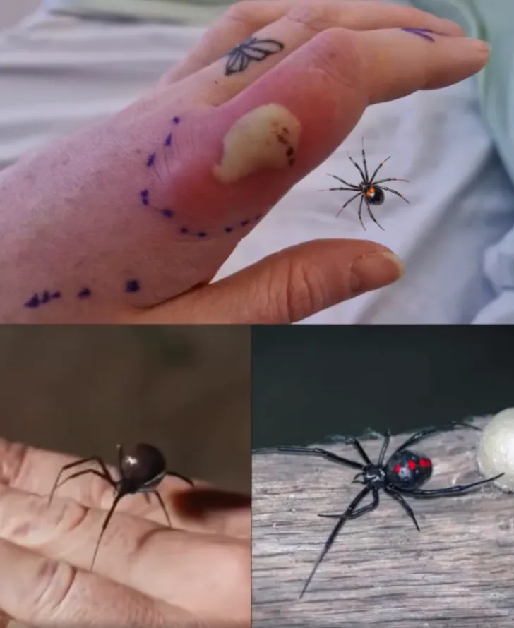 What to do if you get bit.ten by a black widow spider: A complete guide