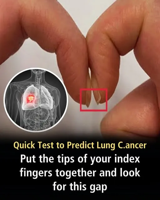 Finger Test For Lung Cancer Could Determine Cancer Risk Finger Test For Lung Cancer Could Determine Cancer Risk