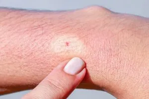 S3. Understanding Severe Swelling from Bee Stings: Causes, Symptoms, Treatment, and Prevention