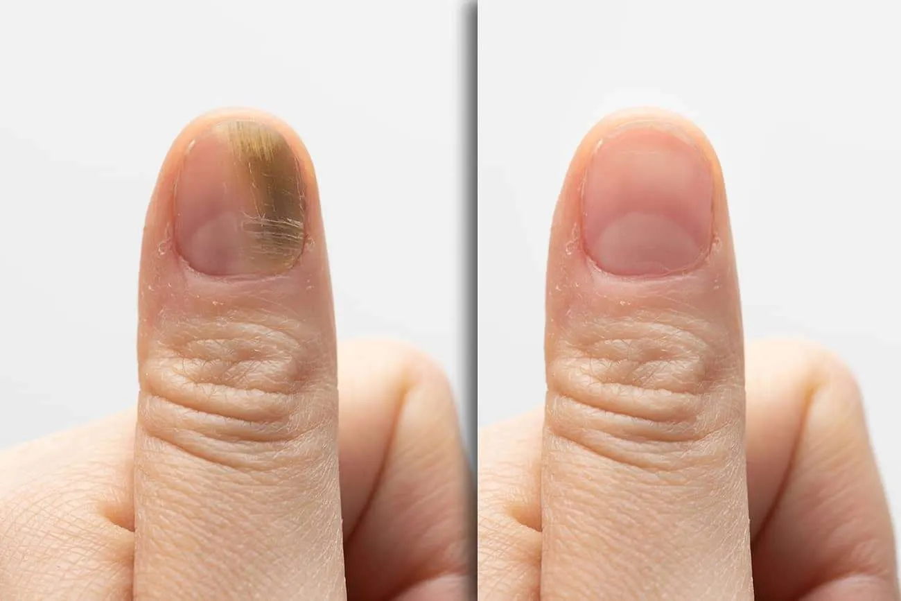 3.. Fungal Nail Infection: Causes, Symptoms, and Effective Treatments