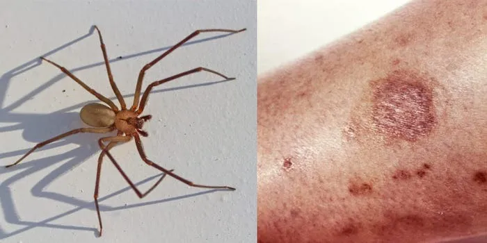 4. What to do if you get bit.ten by a black widow spider: A complete guide