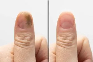 S2. Fungal Nail Infection: Causes, Symptoms, and Effective Treatments