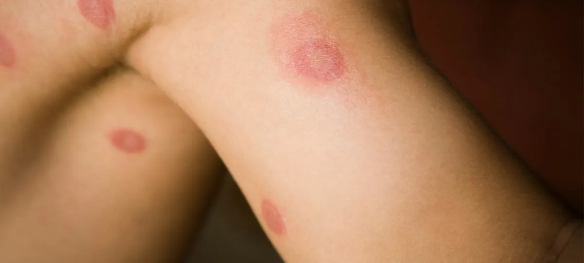 4. Ringworm (Tinea Corporis): Causes, Symptoms, Treatment, and Prevention