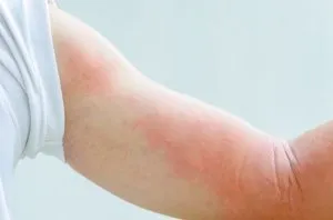 F. Her Whole Body Was Itchy: What She Thought Was a Common Allergy Was Hiding Something More Serious