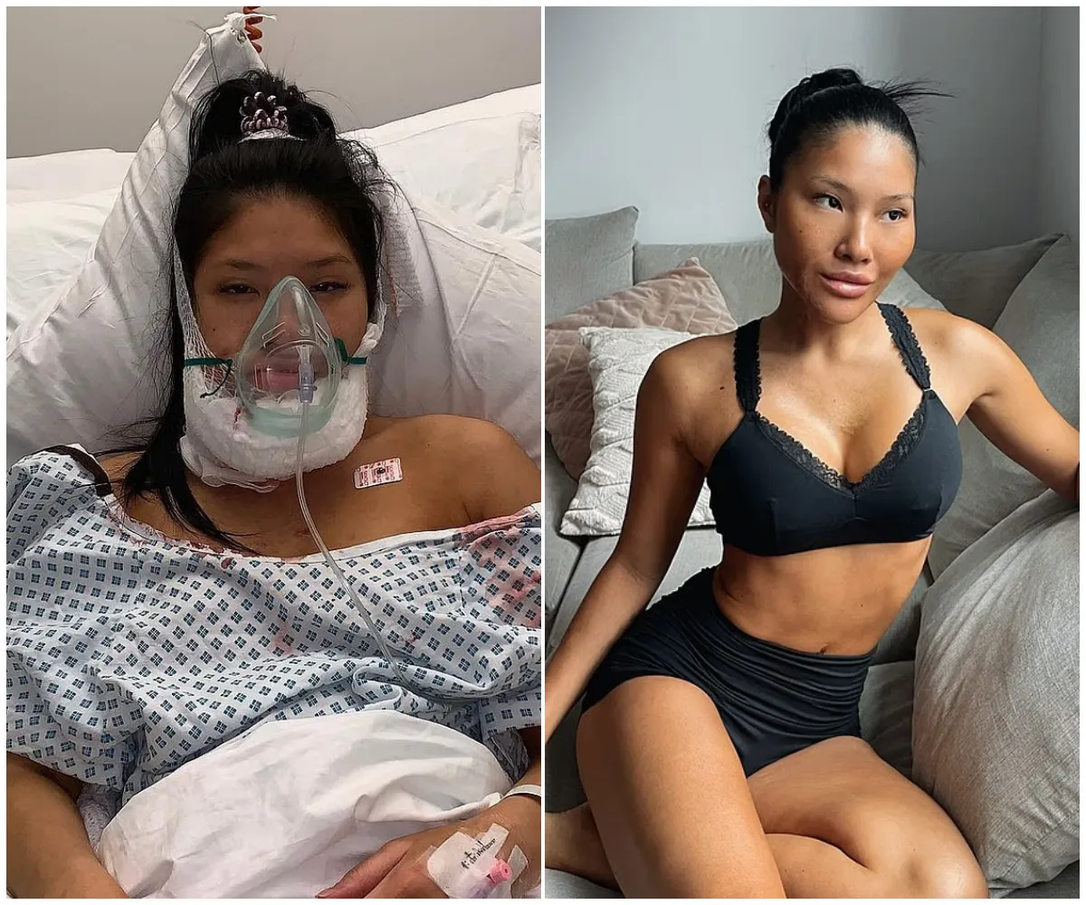 "I basically signed my life away" – Love Island’s Sophie Lee reveals horror fire stunt that left her disfigured, diagnosed with ‘incurable tumour’ and turned her into a global medical experiment - suong
