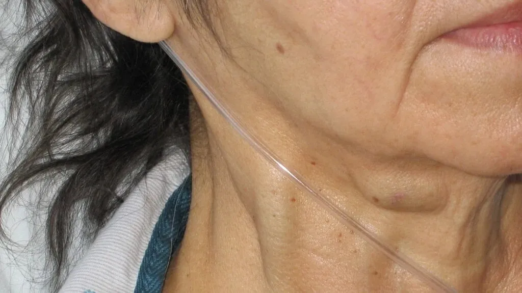 4. Massive jugular vein distension: a sign not to be ignored - Improve your life