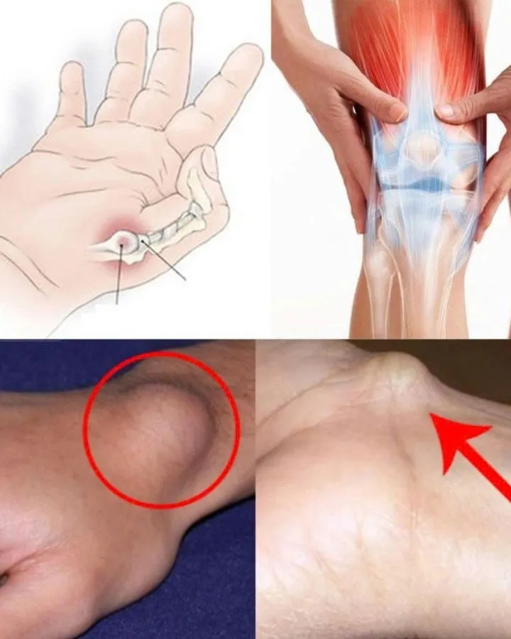 4. A Cyst on the Foot or Wrist: What You Should Know
