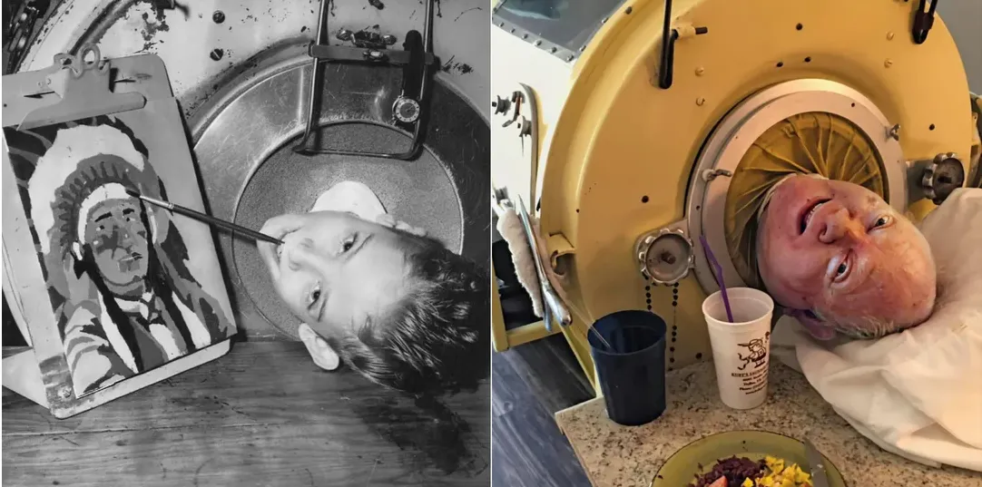 Paralyzed from polio at 6, he was one of the last people with an iron lung – but now there is a sad update