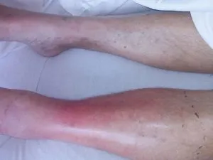 P2. Attention: Recognizing Early Signs of Dangerous Infections