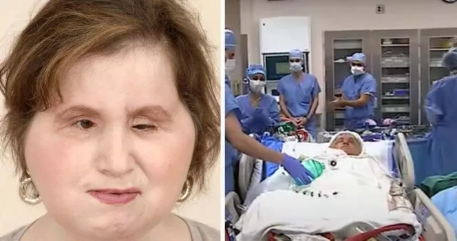 The amazing story of Katie Stubblefield: She became the youngest person to receive a face transplant