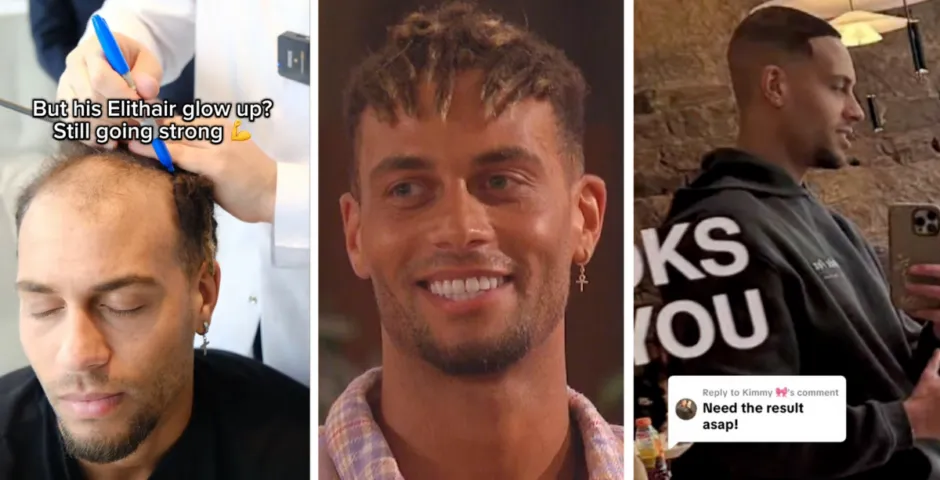 Ouzy reveals hair transplant since Love Island and people are shook by the before and after