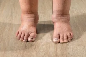P2. Health Warning Signs on Your Feet You Should Never Ignore