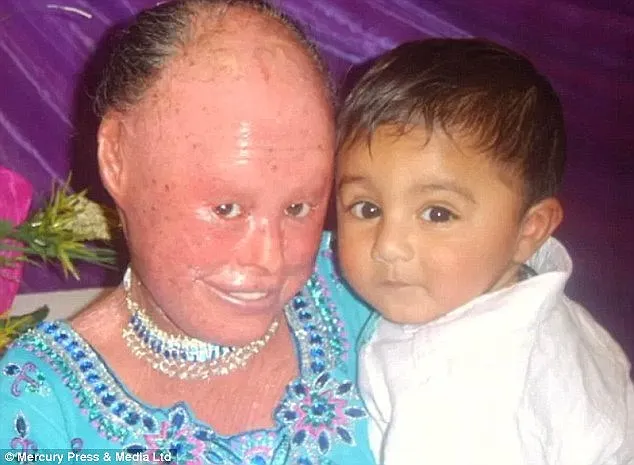 'Snakeskin woman', 33, becomes the oldest ever with a rare condition that causes her skin to grow thick and scaly (and she wants you to know she's just like anyone else)