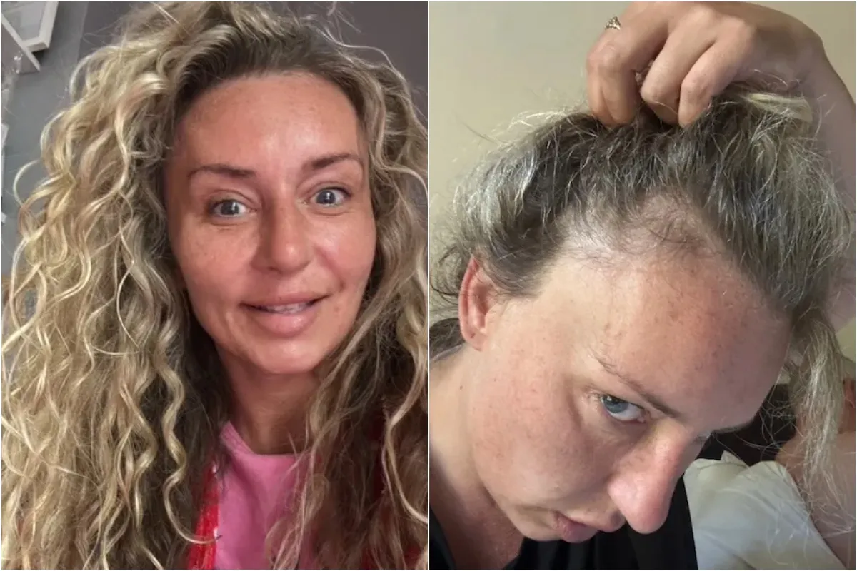 I went on fat jabs but the hair loss was unbelievable so I quit – I’d rather be chubby with hair than ski ngocc