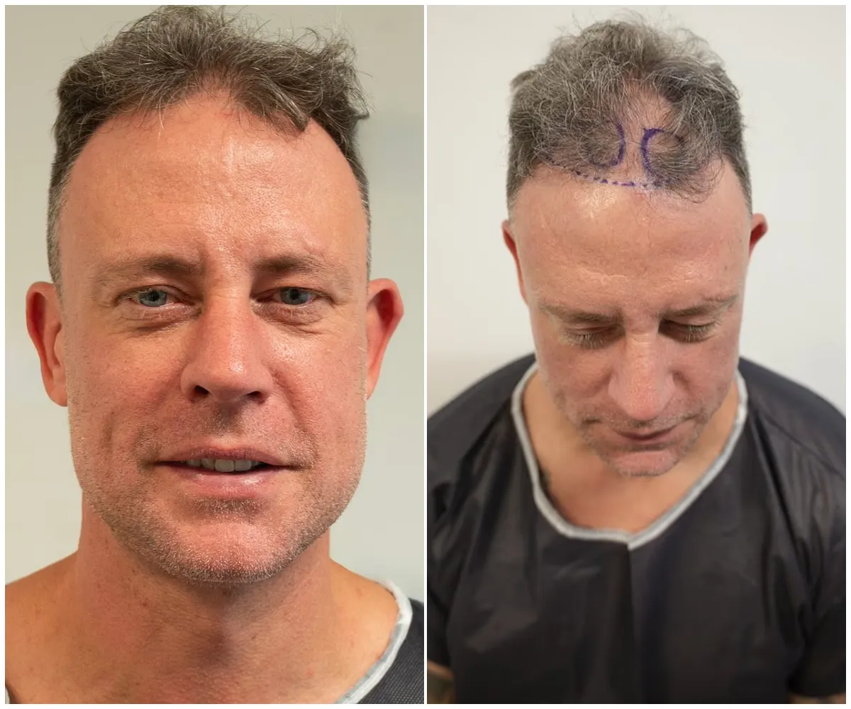 “It’s like I’ve got a full head of hair again” – Wayne Bridge unveils dramatic transformation after £7,000 hair transplant to fix years of thinning, saying the procedure finally gave him back his confidence after a decade of hiding his baldness - suong