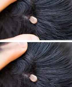 P4. Just discovered this in my son’s hair. What is it? Not sure if we should go to doc