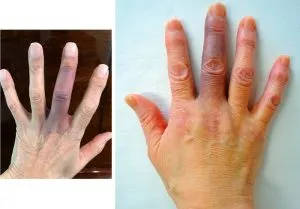 P2. 3 Signs on Your Hands That Could Indicate Heart Disease or Cancer