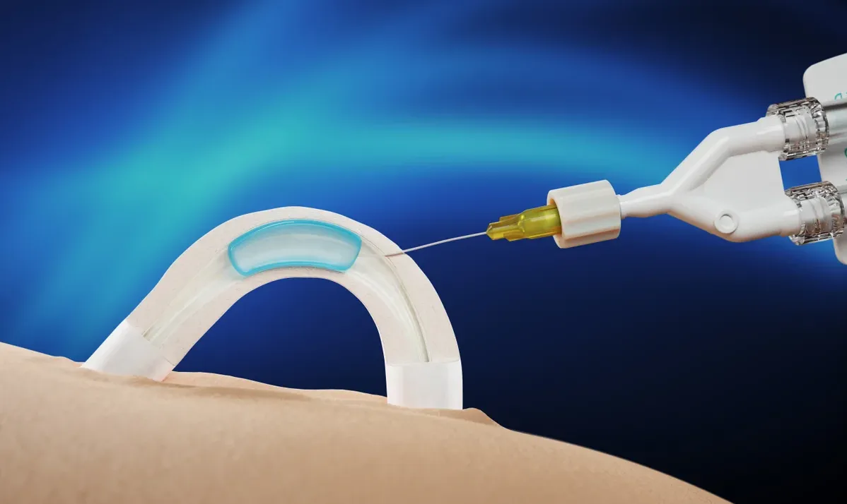 Non-hormonal male contraceptive implant lasts at least two years in trials
