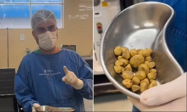 Man who drank up to three litres of Coca Cola every day has to have 35 stones removed from his bladder