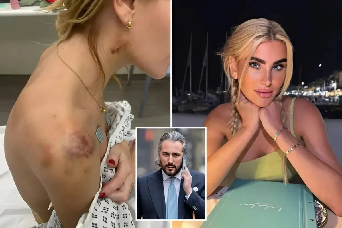 Miss Universe finalist shares pics of horror injuries as ex who called her ‘stupid c***’ in text is cle ngocc