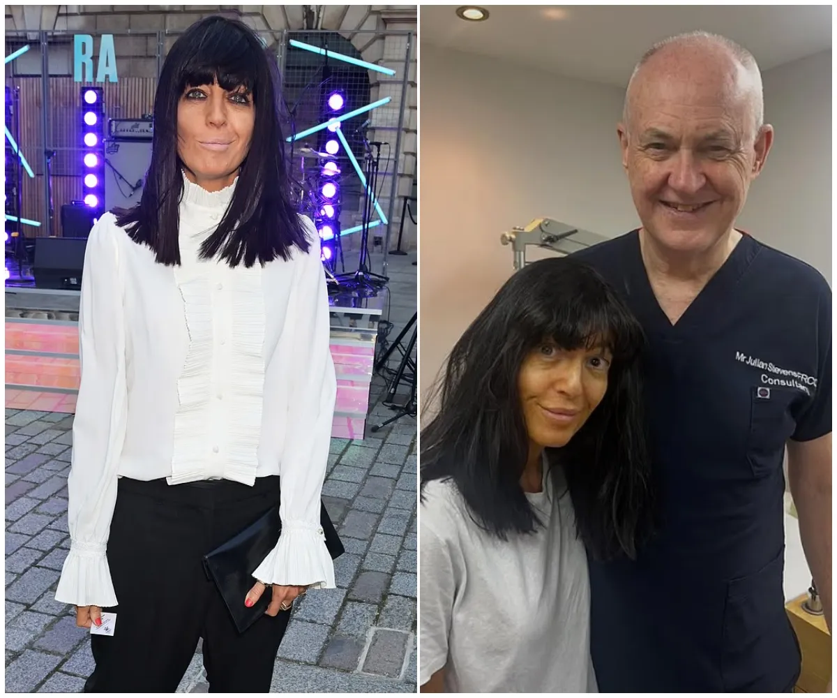 “No eyeliner for weeks” – Claudia Winkleman looks unrecognisable as she ditches trademark look following eye surgery and reveals she’s been banned from wearing make-up and forced to sleep in goggles - suong