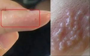 P4.  If You See These Painful Red Bumps, You May Have Dyshidrotic Eczema