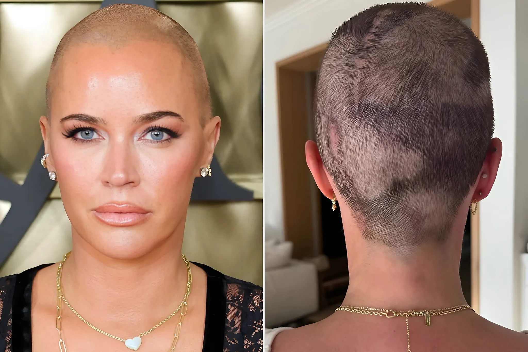 Teddi Mellencamp Reveals Her Battle with Cancer is Worsening, Confronting the Harsh Reality of the Worst-Case Scenario