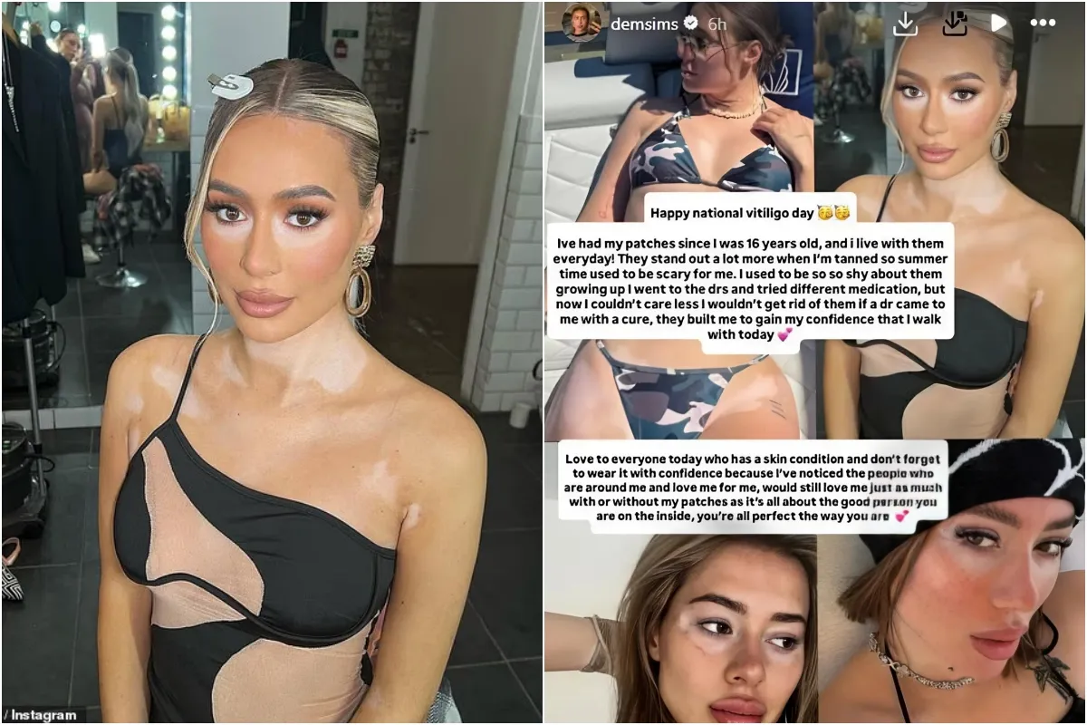 Demi Sims proudly shows off her 'patches' in a slew of candid bikini snaps as she raises awareness for National Vitiligo Day ngocc