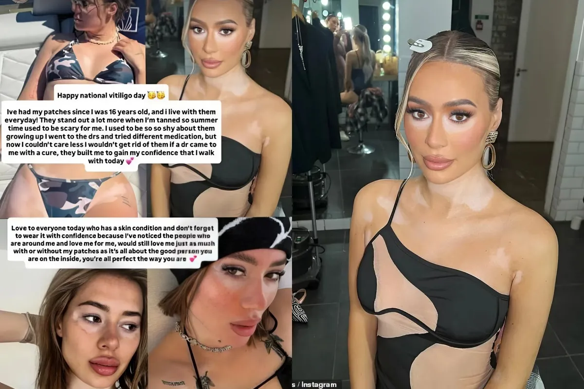 Demi Sims proudly shows off her 'patches' in a slew of candid bikini snaps as she raises awareness for National Vitiligo Day liennhi