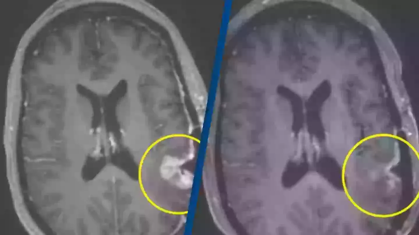 Astonishing cancer breakthrough sees woman's brain tumor almost disappear in just five days