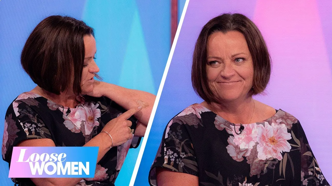 Martine Wright MBE Reflects on 20 Years of Strength and Resilience Since 7/7 Bombings on Loose Women trucc