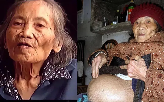Shocking: 92 Year Old Woman Gives Birth To Massive Stone After Sixty Years Of Pregnancy