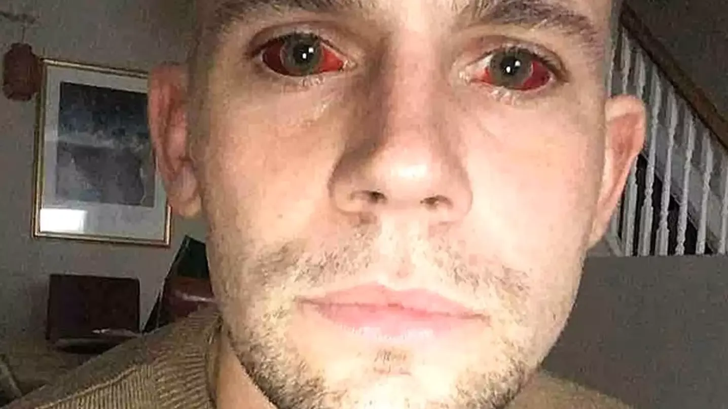 Man issues warning after five-day cocaine binge left him with 'devil eyes' and it almost killed him