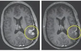 Incredible cancer breakthrough sees woman's brain tumor almost disappear in just five days