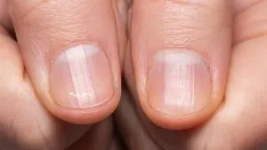 P4. If You Notice These Lines on Your Nails After 40, Here's What It Really Means P4. If You Notice These Lines on Your Nails After 40, Here's What It Really Means