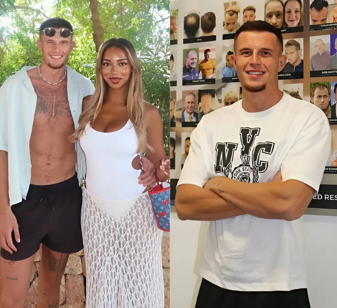 Love Island star reveals he’s getting a hair transplant as he shaves head after ‘struggling for years’