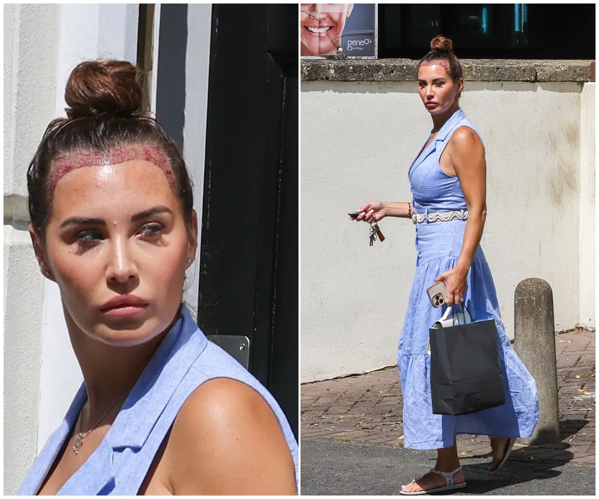 ‘I spent six years hiding my body’ – Chloe Goodman reveals shocking results of hair transplant as she’s seen leaving clinic in full glam just days after opening up about scars, self-hatred and secret struggle with body confidence - suong
