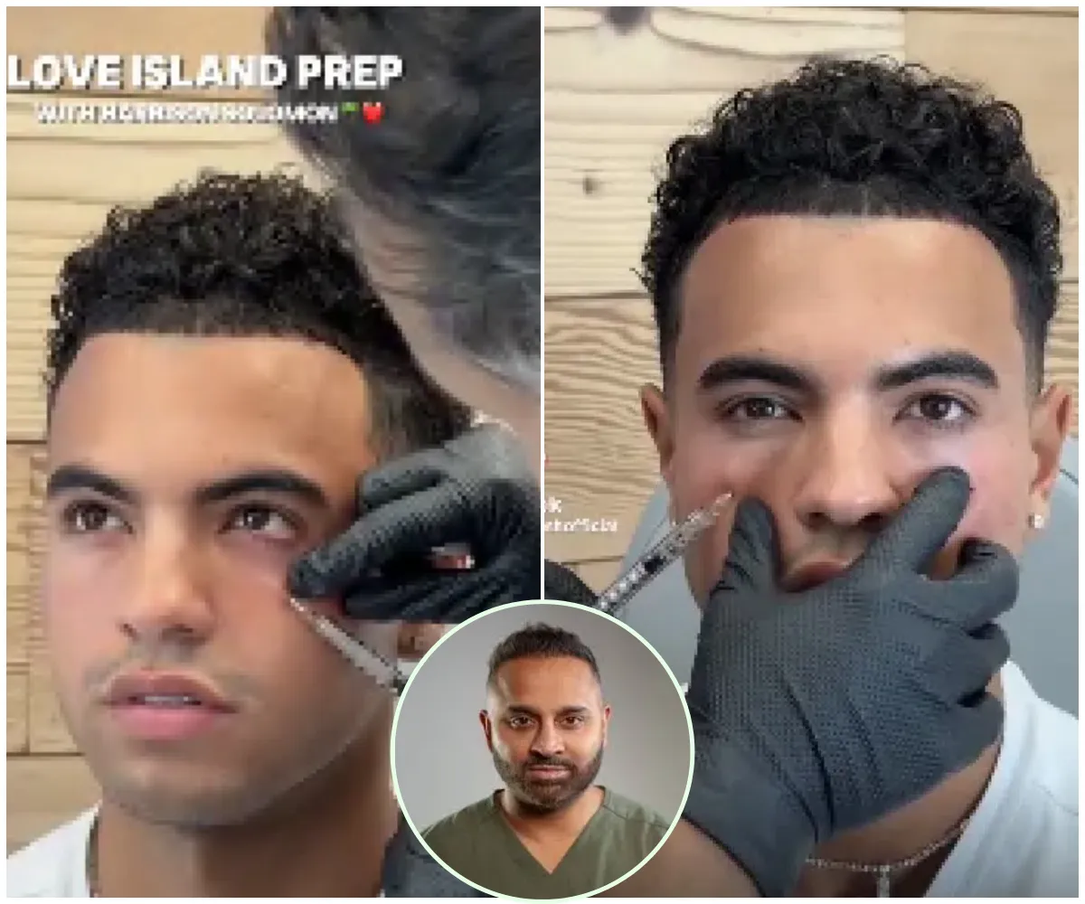 “Under eye refresh, ready for the villa” – Love Island’s Harrison, 22, unveils secret pre-show glow up with celebrity doctor as it’s revealed he had tear trough filler just days before turning heads in Casa Amor - suong