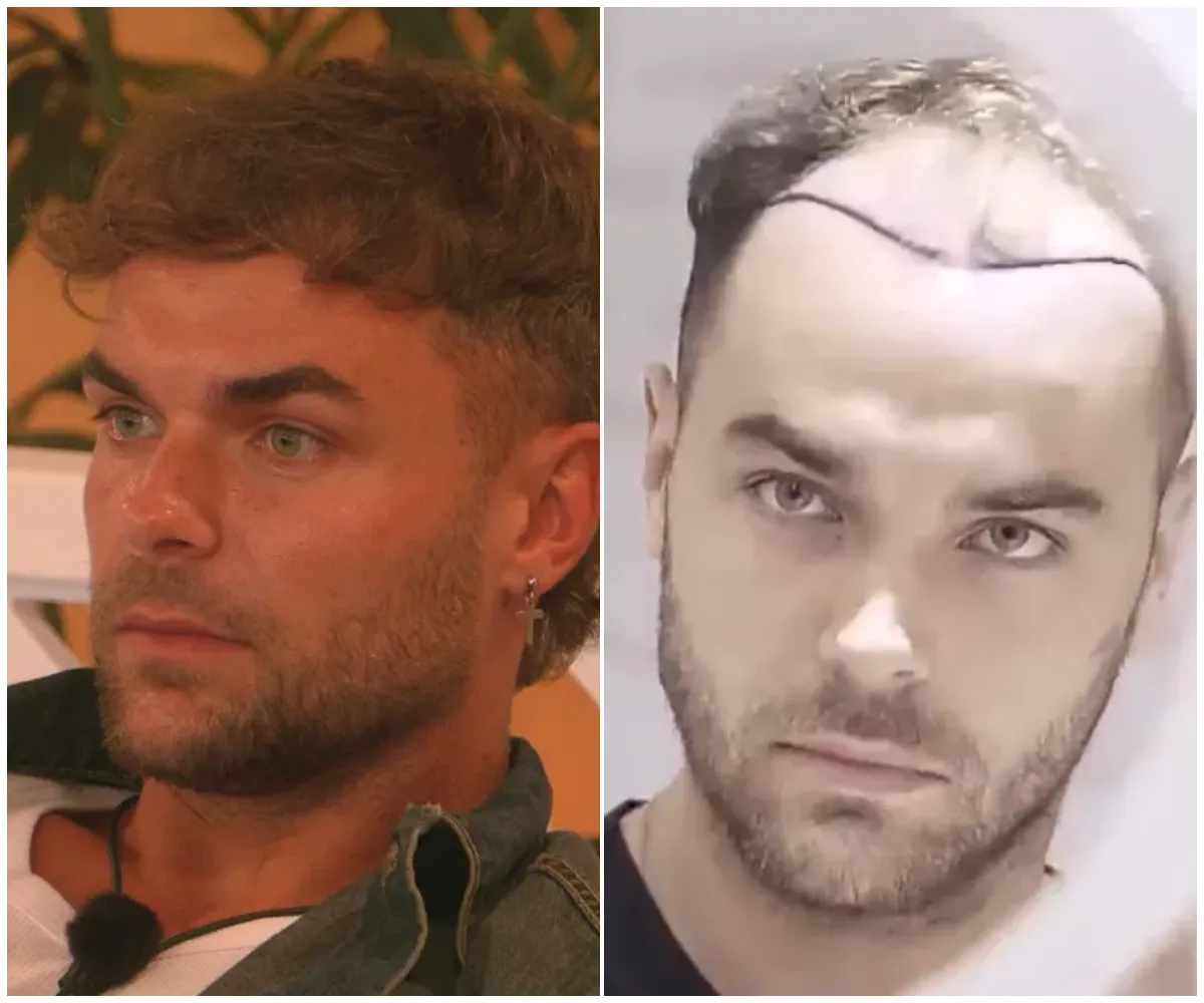 “Harry glow up is mad” – Love Island fans stunned as old videos of Harry Cooksley resurface showing his dramatic transformation before the villa, sparking speculation over jaw filler and a secret trip to Turkey for a hair transplant - suong
