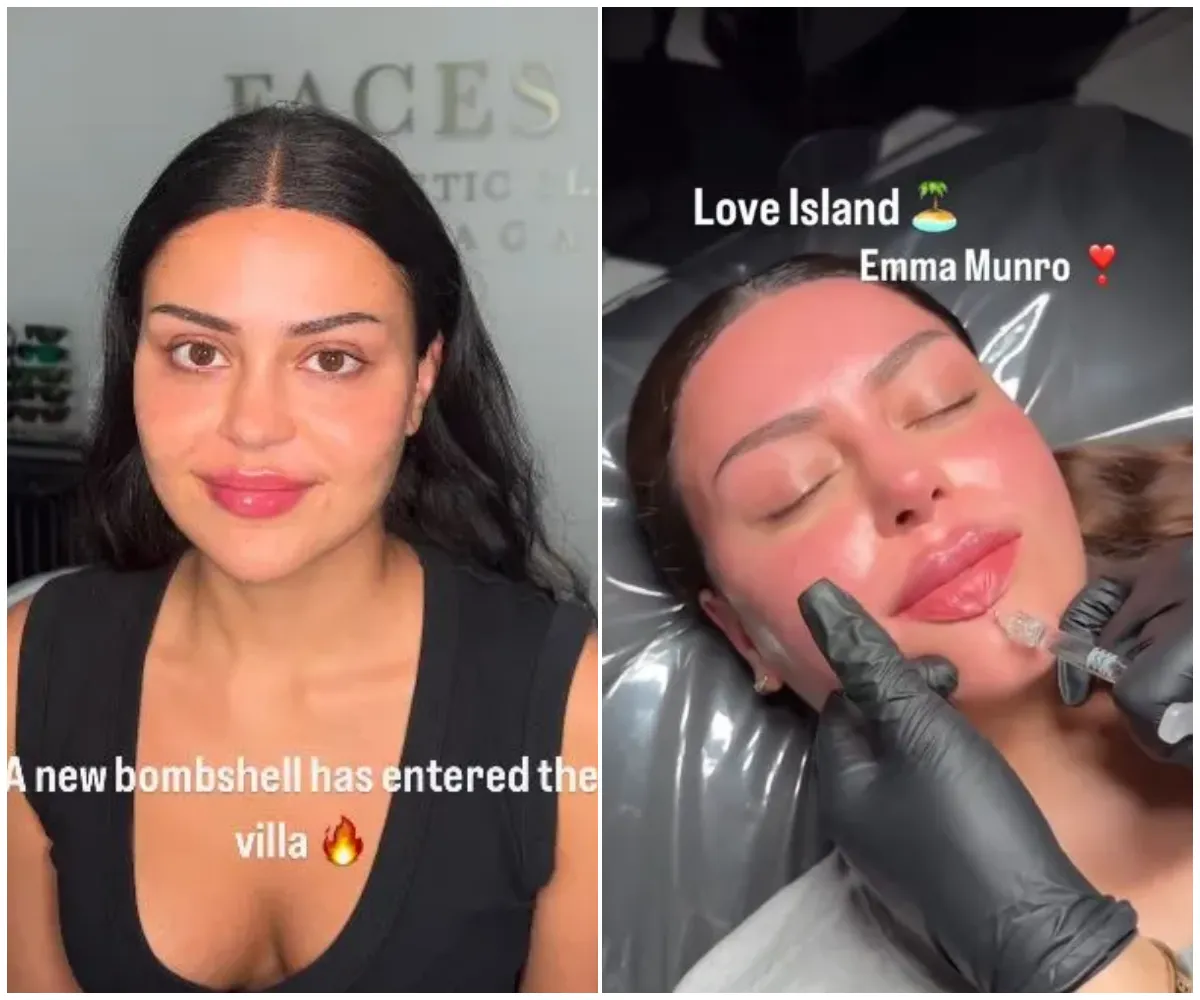 “A new bombshell has entered the villa” – Love Island star Emma Munro’s pre-villa glow up revealed as she splashes out on lip, chin, and cheek fillers before dramatic on-screen reunion with ex Harry in the most talked-about twist of the series - suong