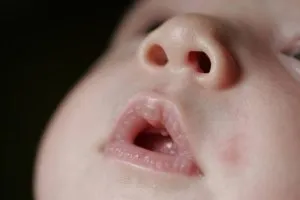 P1. If your baby has these marks it means… See more