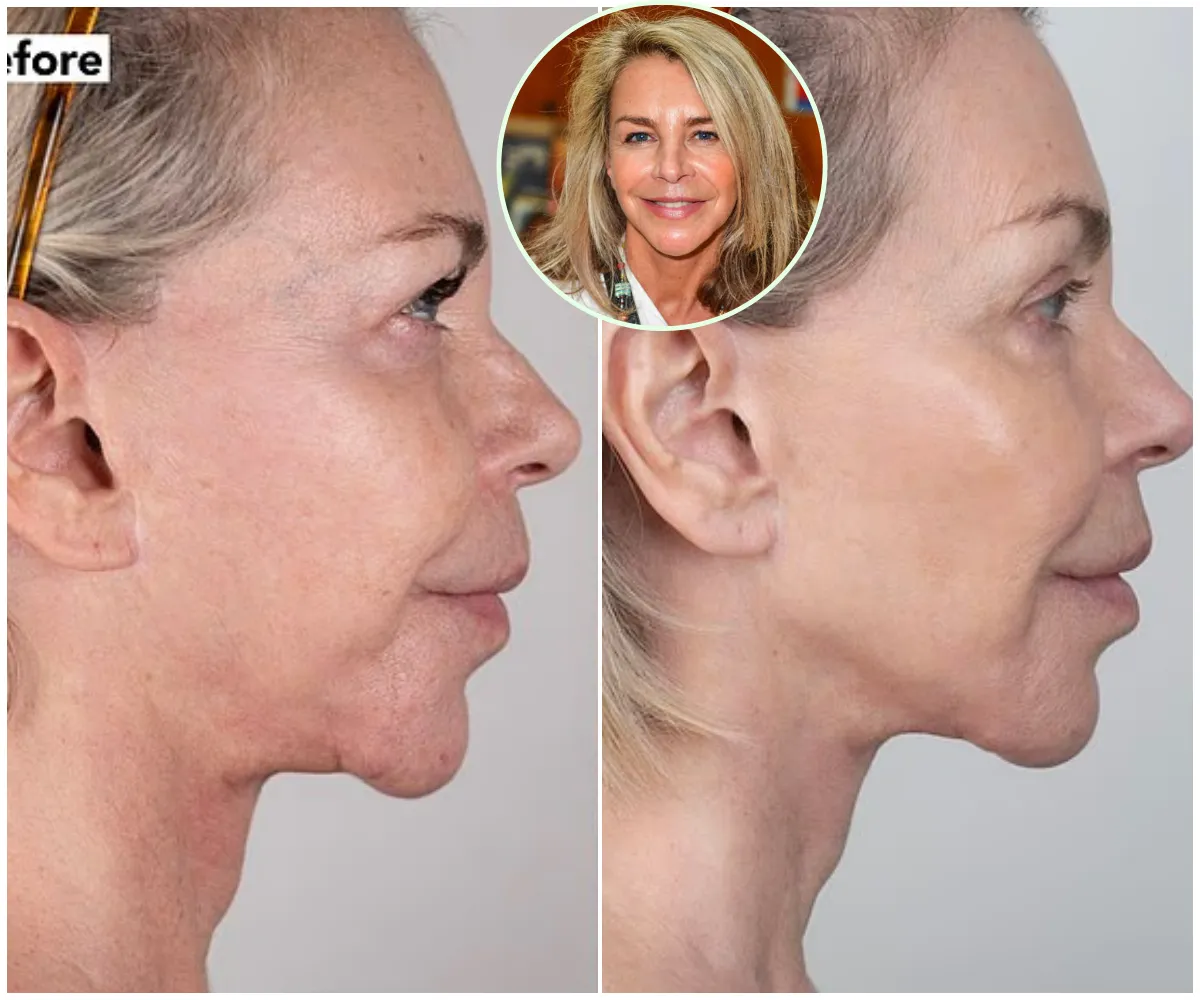 “It’s just me — but a much better version” – Leslie Ash, 65, unveils her youthful new look after £4,500 non-surgical facelift she claims made her look ten years younger… 23 years after botched lip fillers sparked the infamous ‘trout pout’ scandal - suong