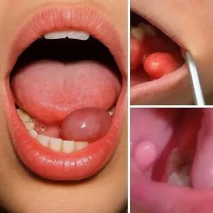 P4.  These are the first symptoms of a...