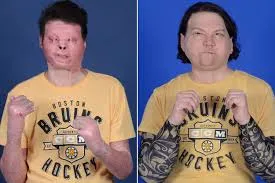 22-Year-Old Undergoes World's First Successful Face and Hands Transplant: 'I Feel Really Grateful'