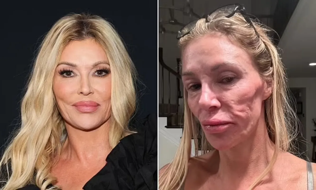 Brandi Glanville slams doctors over facial parasite crisis after spending $70K on plastic surgery consultations